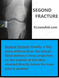 Image result for Segond Fracture