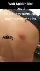 Image result for wolf spider bite skin