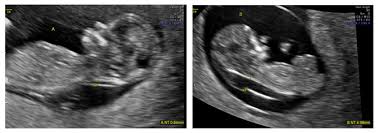 Image result for First Trimester Ultrasound