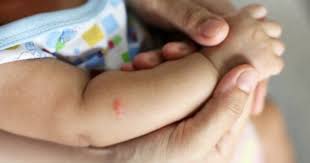 Awas Ini 6 Jenis Penyakit Kulit Pada Bayi Yang Sering Dijumpai Popmama Com