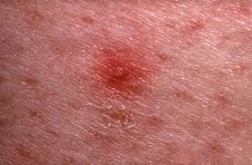 Image result for skin rash acute hiv infection