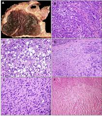 We did not find results for: Pathology Of Malignant Pleural Mesothelioma Thoracic Surgery Clinics