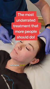 Peeling for Team Explained