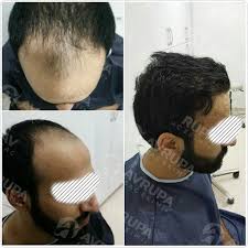 تجارب زراعة الشعر في تركيا 2019 مقارنات وابحاث مهمة قبل اجراء عملية زراعة الشعر