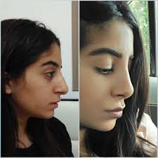 Rhinoplasty Before And After ניתוח אף פלסטי דר אייל סלע