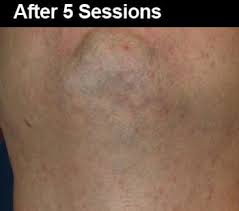 As mentioned at the beginning of this blog post, it is the industry minimum and standard for a treatment. Laser Hair Removal Atlanta Reviews Benefits Side Effects