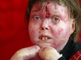 How I learned the miracle of Jonathan Pitre, Ottawa's Butterfly Child