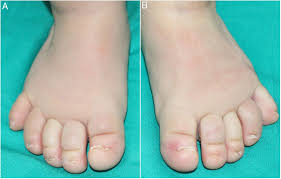 Image result for Koilonychia feet