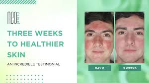 Acne Scarring: Nanotechnology Microneedling NeoGenesis