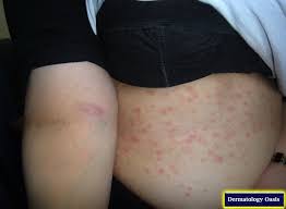 Pityriasis alba is a skin disorder that mostly affects children and young adults. Pityriasis Rosea Dermatology Oasis