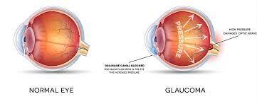 Glaucoma Diagnosis Jacksonville | Glaucoma Tests Jacksonville, Nc