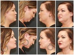 There S More Than One Way To Rejuvenate The Neck