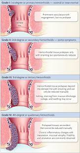 Image result for hemorrhoids