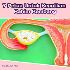 Operasi angkat rahim akan menyebabkan infertilitas atau kemandulan. Mamadil Dungun 7 Petua Untuk Kecutkan Rahim Kembang Facebook