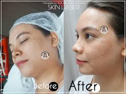 Results may vary from patient to patient. Chit Chat Pengalaman Bule Laser Kulit Wajah Di Jpp Skin Laser Clinic Buleipotan Beauty Blogger Indonesian