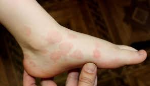 Image result for Erythema Multiforme Causes