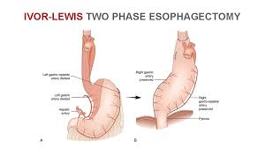Apr 21, 2020 · after esophagectomy, however, a feeding jejunostomy is preferred to ng feeding. 79 Year Old Gentleman With Progressive Dysphagia Mbbs