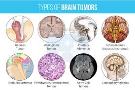 A brain tumor is a mass or growth of abnormal cells in your brain. 2017 09 19 Canada Medical System Not Tracking All Brain Cancers Coalition To Stop Smart Meters In Bc