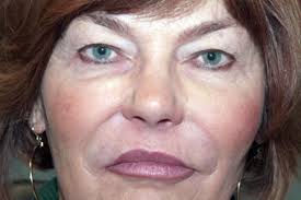 Use of facial fillers