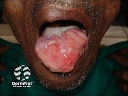 Image result for Stibogluconate