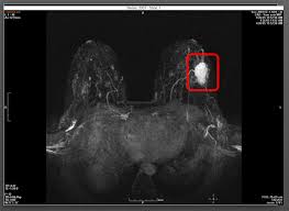 Breast mri images are combined, using a computer, to create detailed pictures. Rapid Breast Mri Could Save Thousands From Cancer Regional Medical Imaging
