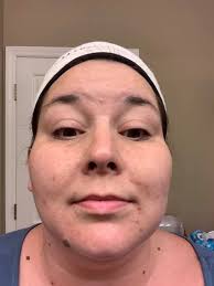 Anyone ever done a chemical peel??