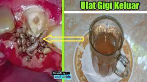 Kalau gigi sudah terlanjur berlubang, gimana cara merawatnya? Sakit Gigi Sembuh Ulat Gigi Keluar Semua Manjur Bro Youtube