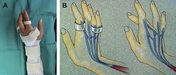 Image result for Elson Extensor Tendon Test