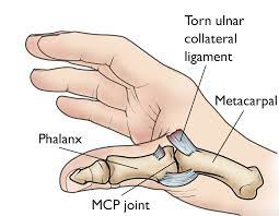 Sprained Thumb - Orthoinfo - Aaos