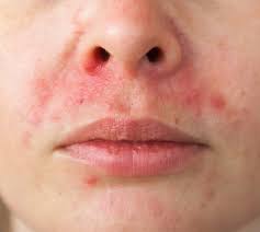 perioral dermatitis what is it and how can your skin care help to cu perioral dermatitis perioral skin care help