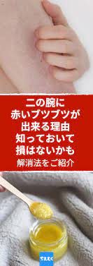 半袖やノースリーブを着る季節 腕をブツブツを気にするあまりちょっぴり憂鬱な気分になることもあるでしょう 思い当たる人は一般的に さめ肌 と呼ばれる皮膚疾患の一つ 毛孔性角化症 毛孔性苔癬 を発症しているかもしれません 健康上重大な問題はありませんが
