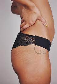 Check spelling or type a new query. 19 Best Stretch Mark Removal Creams Tips To Get Rid Of Tiger Stripes Stretch Mark Removal Cream Best Stretch Mark Removal Best Stretch Mark Creams