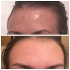 Witch hazel leaf extract, bark extract, and witch hazel water are used as astringents which can tighten the skin. This Highly Rated Witch Hazel Toner Is The Best Skin Care Product Under 10