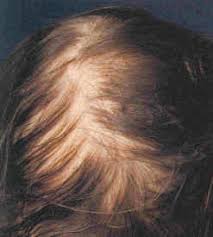 Telogen Effluvium Dallas | Chronic Telogen Effluvium in Women Plano, TX