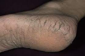 Why Is The Bottom Of My Foot Dry And Cracked Tanglewood Foot Specialists