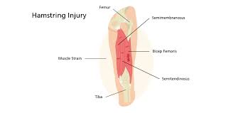 Image result for Hamstring Strain