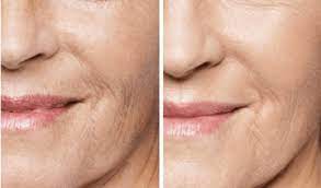 We did not find results for: Aquagold Baby Botox Aesthetics Glow