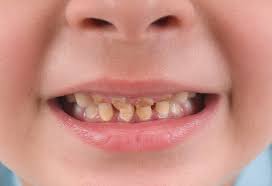 Yellow And Other Tooth Discoloration In Children