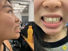 How to reduce gap between teeth naturally home remedies how does invisalign® fix gapped teeth in 2020 gap teeth fix gaps between teeth with veneers and crowns at dr I Swear By Teeth Straightening Service Zenyum But Here S The Catch Lifestyle News Asiaone