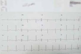 There are other signs that accompany the vertigo that will let you know if you need to see a doctor right away. Racgp Dizziness If Not Vertigo Could It Be Cardiac Disease