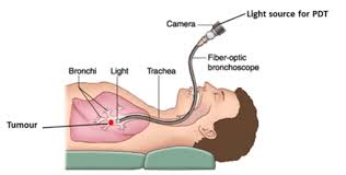 Image result for Porfimer