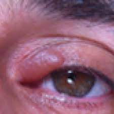 Flurbiprofen Induced Unilateral Eyelid Angioedema Mdedge Dermatology