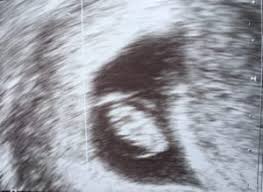 Wann kommt mein kind auf die welt? Wie Du Schon Beim Ersten Ultraschall Das Geschlecht Deines Babys Erfahren Kannst Faminino