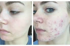 Learn about the best ways to get of of acne scars naturally. How To Get Rid Of Acne Scars Fast 9 Best Home Remedies
