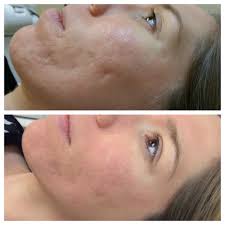 Before and after nonablative fractionated laser, ablative fractionated co2 laser and broad band light treatments to burn scars on the chest photo courtesy of jill s. Fractional Laser Scar Treatment Services Skin Resurfacing