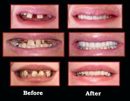 Continue reading to learn more about how long does it take to have dentures made. It May Take Some Time To Get Used To The Way Dentures Feel In Your Mouth But The Benefits Ou Tooth Extraction Tooth Extraction Aftercare Tooth Extraction Care