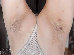 Tria laser hair removal 4x us: Tria Hair Removal Laser 4x 3 Months Laser Free Lavenderlilac Dream