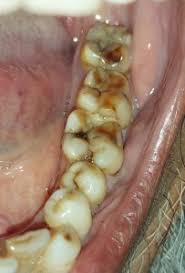 Image result for Pulpitis
