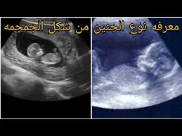 معرفه نوع الجنين من شكل الجمجمه جمجمه الجنين وعلاقتها بنوعه youtube