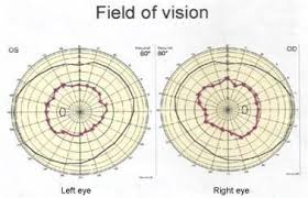 Perimetry Chart Field Of Vision Normal Vision Marked By